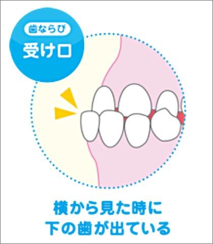 歯ならび 受け口 横から見た時に下の歯が出ている