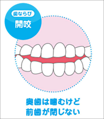 歯ならび 開咬 奥歯は噛むけど前歯が閉じない