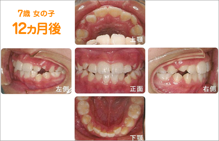 7歳 女の子 12ヵ月後　上顎・左側・正面・右側・下顎