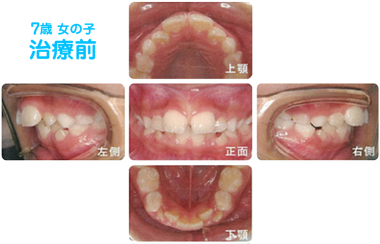 7歳 女の子 治療前　上顎・左側・正面・右側・下顎