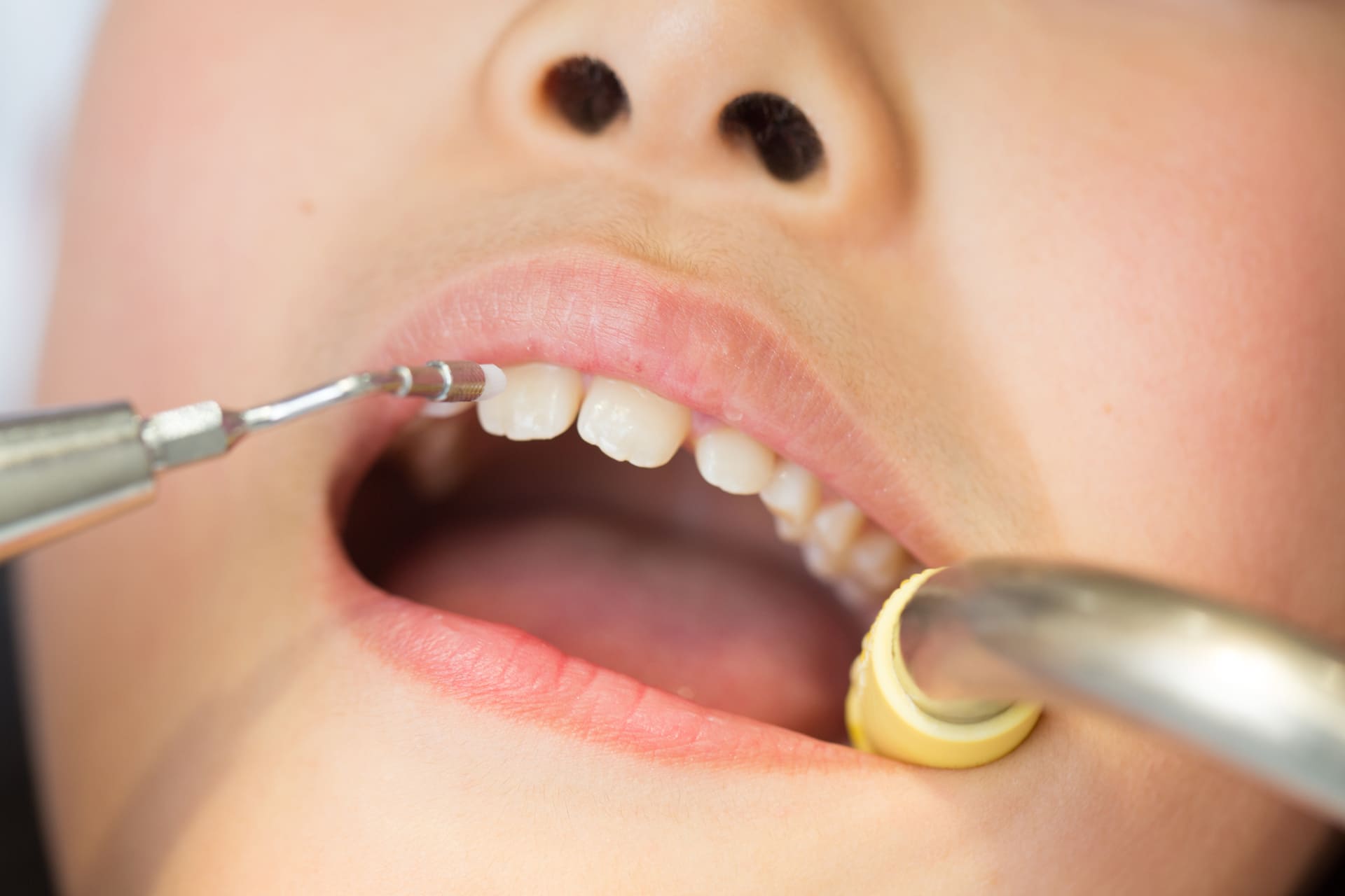 痛みなく早く予防