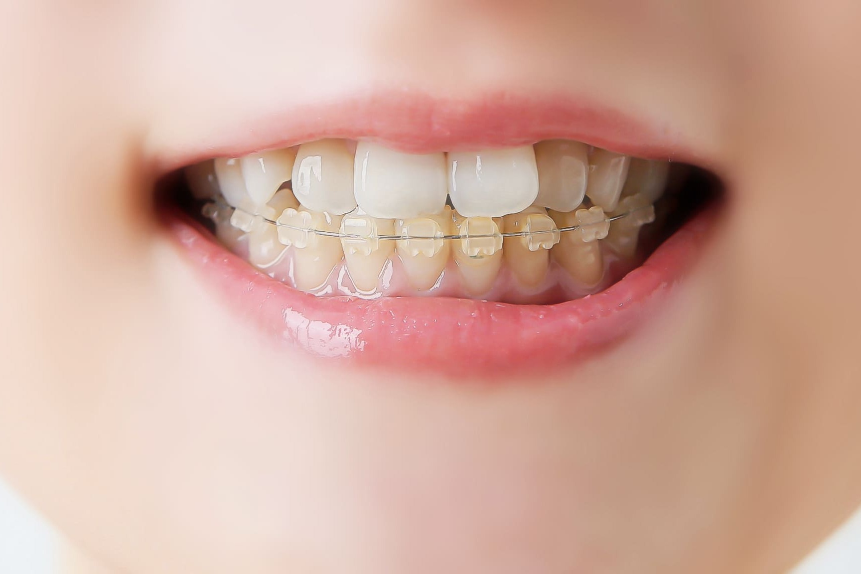 ワイヤーを使った矯正（ブラケット矯正）