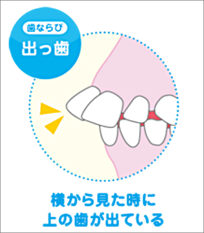 様々なタイプの歯ならび